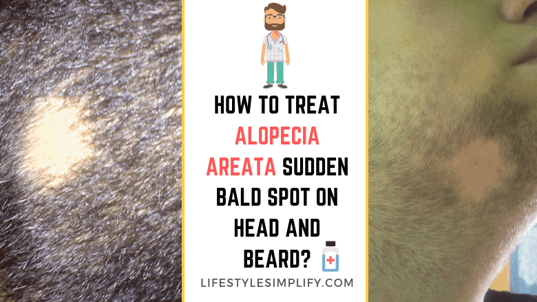 Treat Alopecia Areata Sudden Bald Spot on Head and Beard