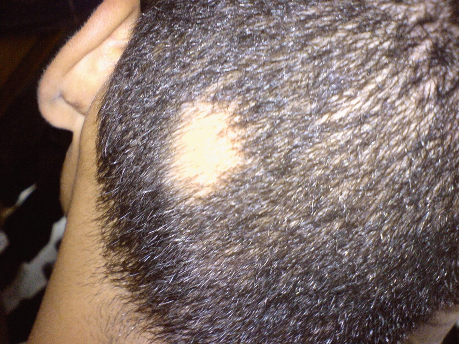 How to Treat Alopecia Areata Sudden Bald Spot on Head and Beard?