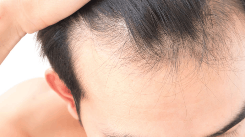 Cure For Baldness And Alopecia
